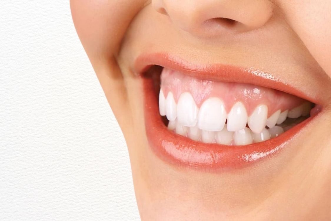 Gummy smile treatment dubai