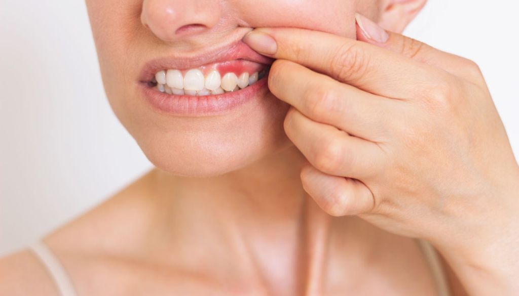 Understanding Gingivitis: Symptoms, Causes, and Treatment