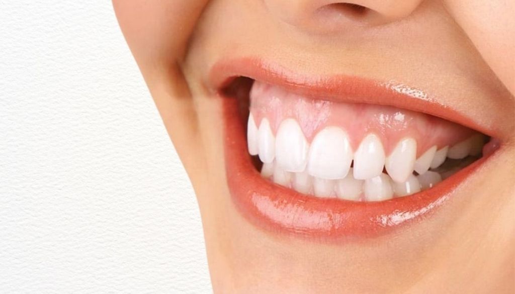 Gummy Smile Treatment Options at Italian Dental Clinic