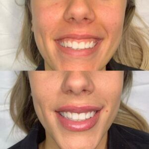 gummy smile treatment in dubai